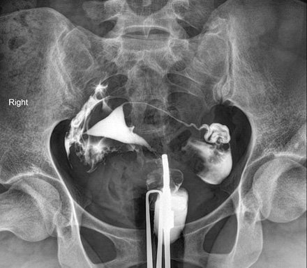 hsg x ray